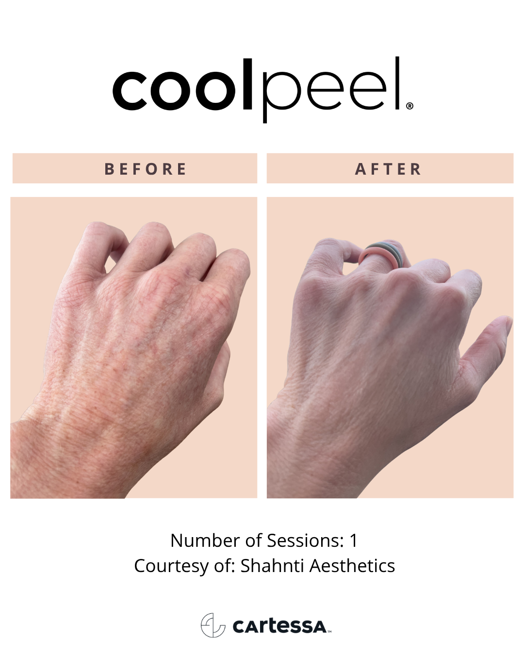 CoolPeel Before and After - Hands