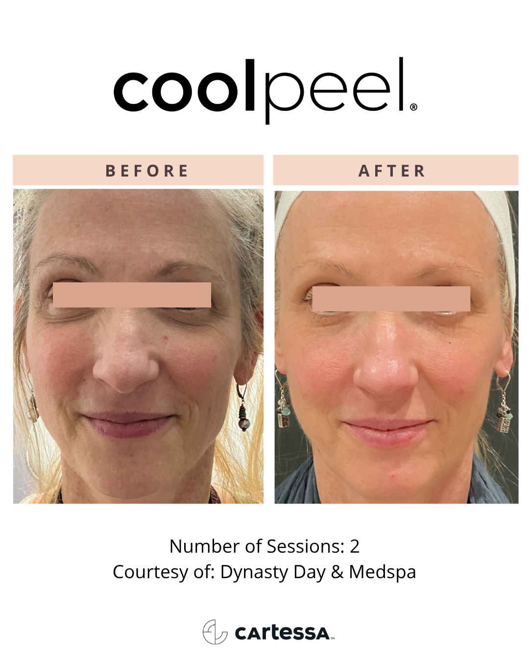 CoolPeel Before and After - Full Face