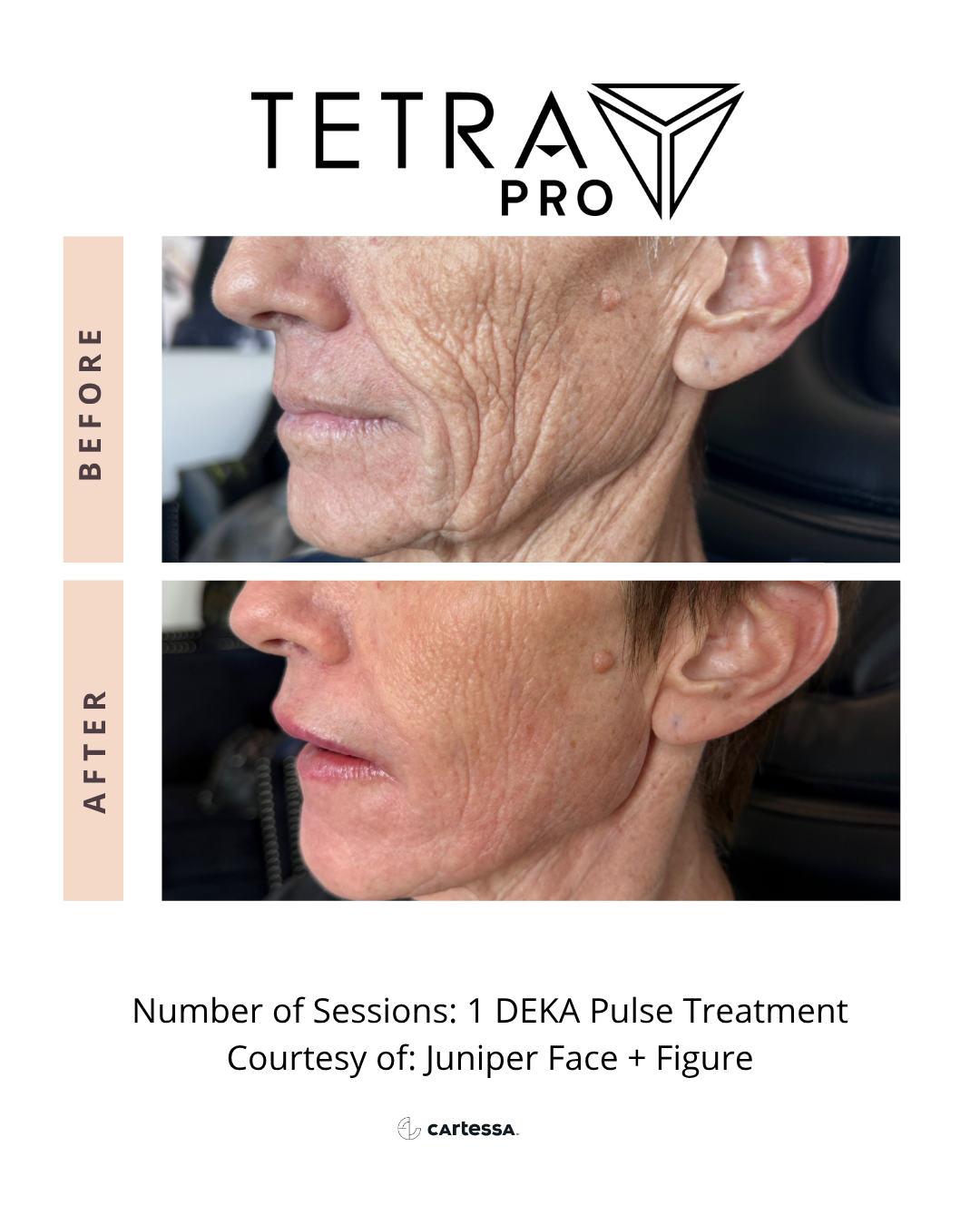 Tetra Pro Before and After - Lower Face Wrinkles