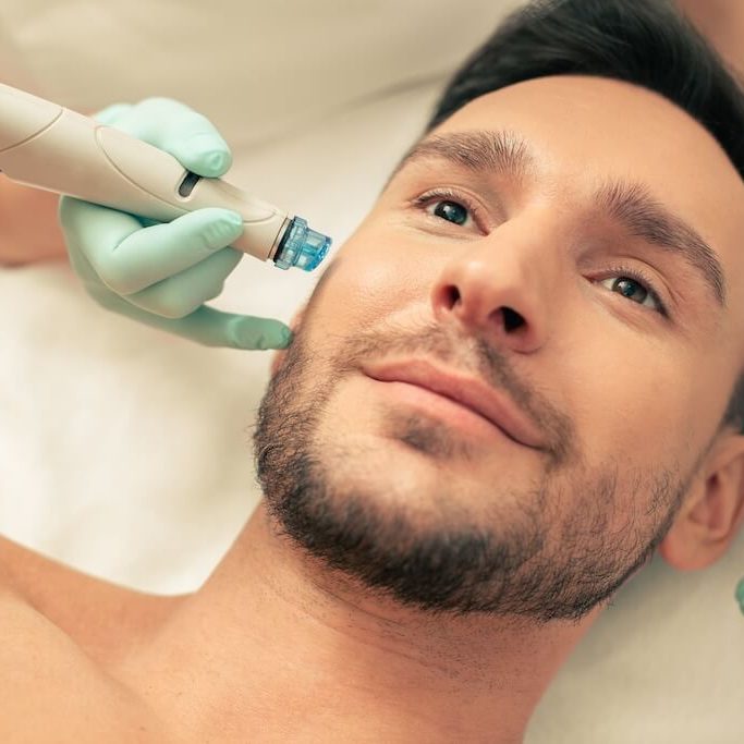 Woman undergoing microneedling for hair loss with a Skin Sanctuary Injector