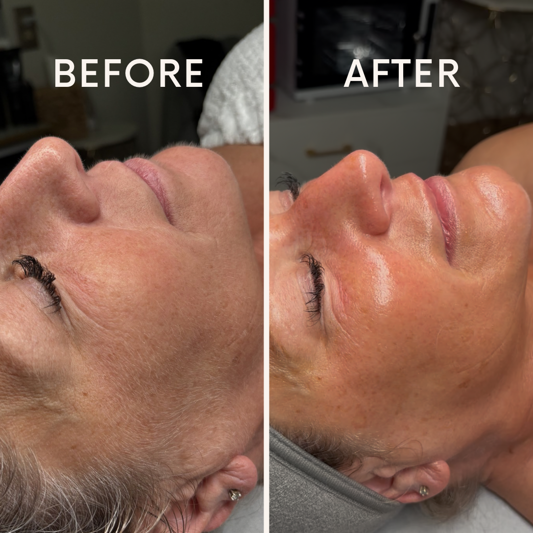 before_after Signature Renewal Facial + Dermaplaning