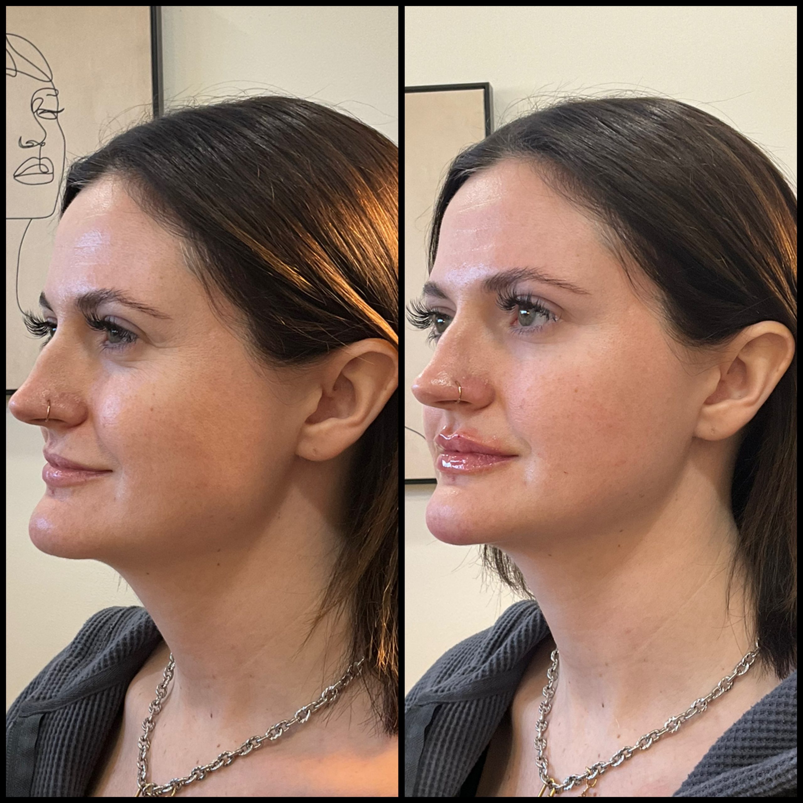 before_after half syringe of filler