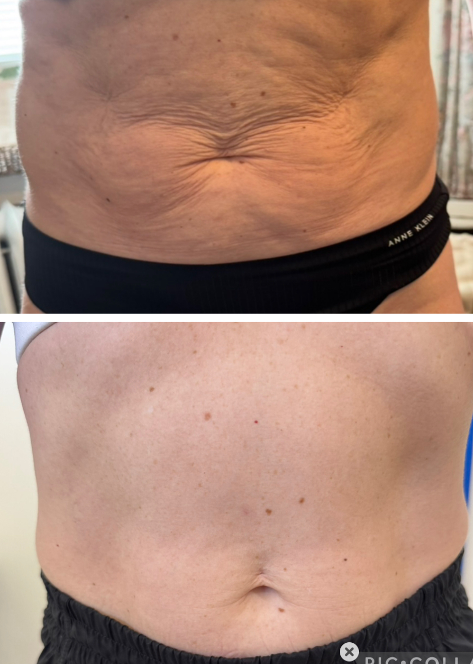 before_after hyperdilute radiesse