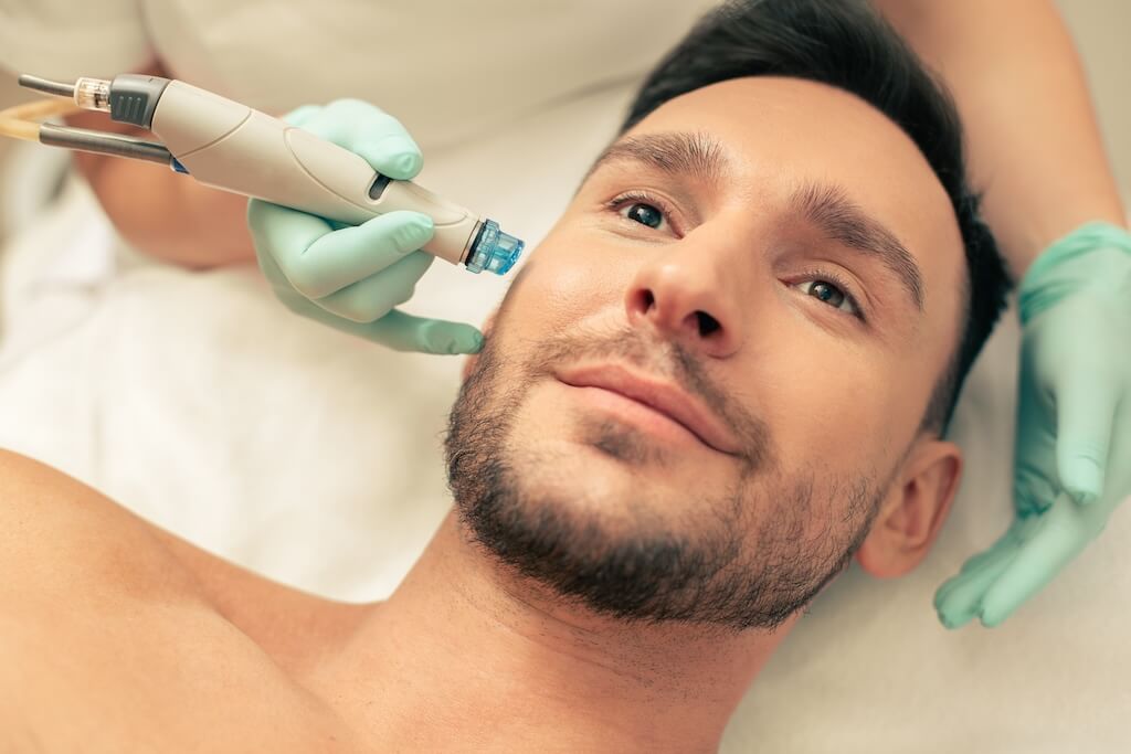 close-up-face-smiling-bearded-man-undergoing-pleasant-skin-nourishing-procedure Woman undergoing microneedling for hair loss with a Skin Sanctuary Injector