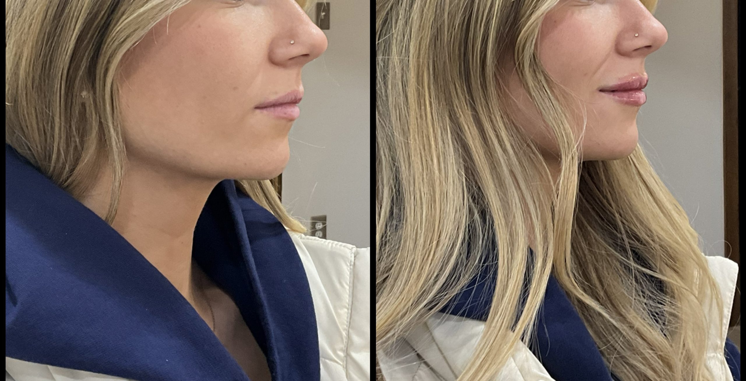 lip filler before_after