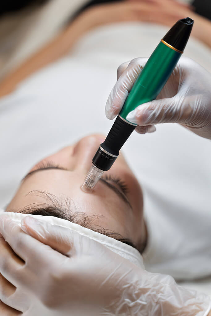 Woman getting Microneedling at Omnia Integrative Health & MedSpa in West Lawn, PA